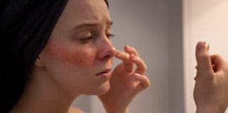 Gonfiore, sfoghi e mal di testa? Potresti avere l’allergia al nichel senza saperlo